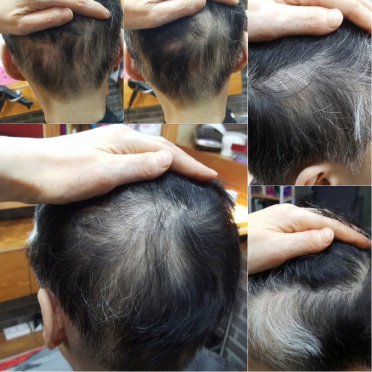  원형탈모 다발성탈모  패션가발 안 할 수가 없죠!