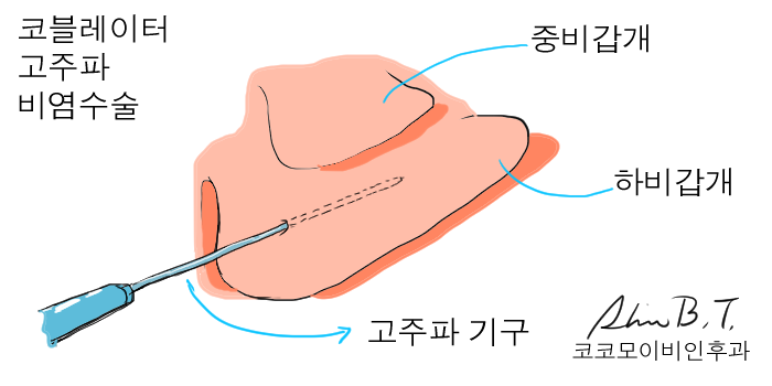  코비염수술 알레르기비염수술의 실비보험 적용과 낮병동 입원
