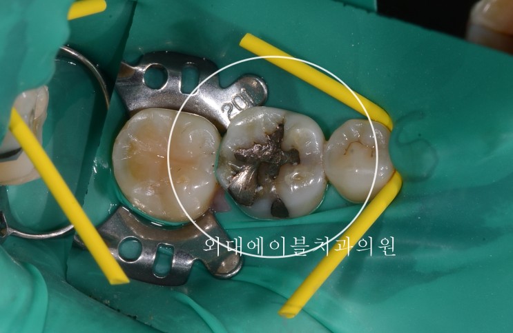 [이문동, 회기동 치과]아말감 재치료 - 아말감으로 떼운 이빨 레진치료