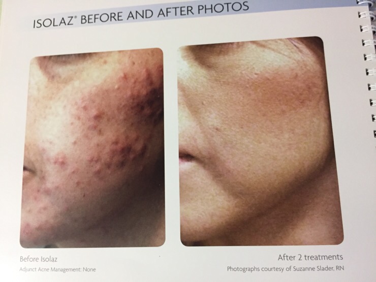  Isolaz Acne 여드름 치료 Laser