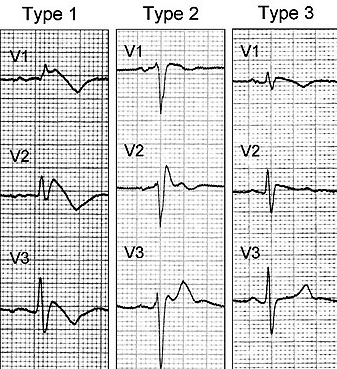Brugada syndrome : 네이버 블로그