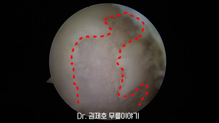  무릎연골 줄기세포치료 직접 알려드려요