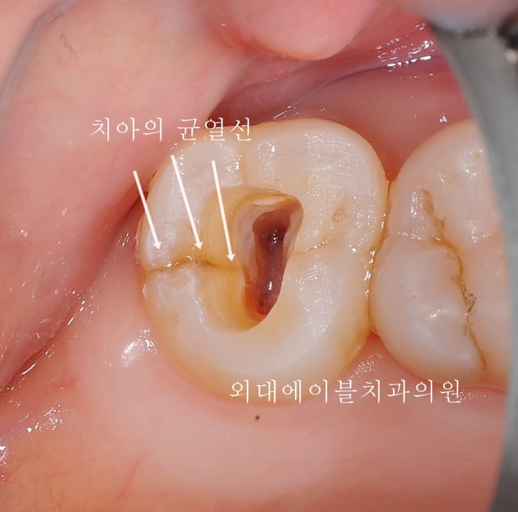 [이문동, 회기역 치과] 치아 금가는 경우, tooth crack syndrome, 원인과 대처법 1편