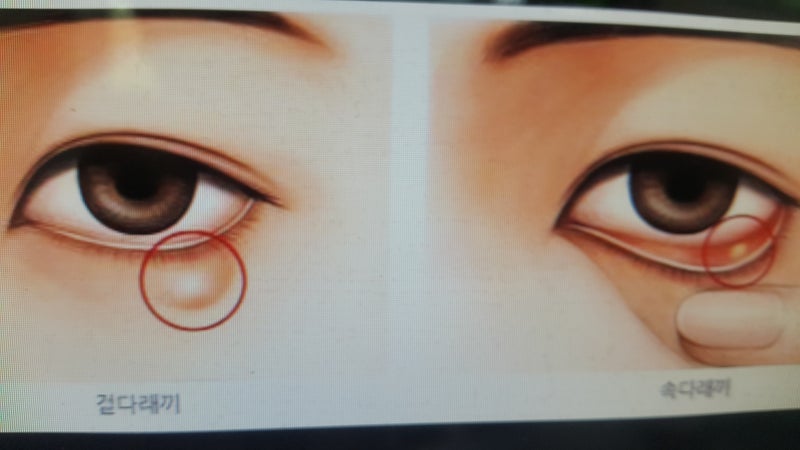 눈다래끼음식도 조심하셔야 되요
