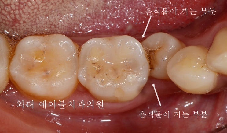 [이문동, 회기동 치과] 이빨 사이 음식물이 많이 낄때 - marginal ridge discrepancy