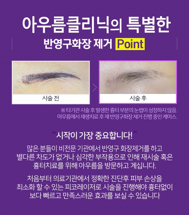눈썹문신제거후관리 이렇게 케어해요 8