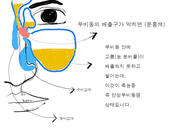 뇌경색 후유증 수술 후 (말초신경손상, 손목관절수술, 축농증수술)