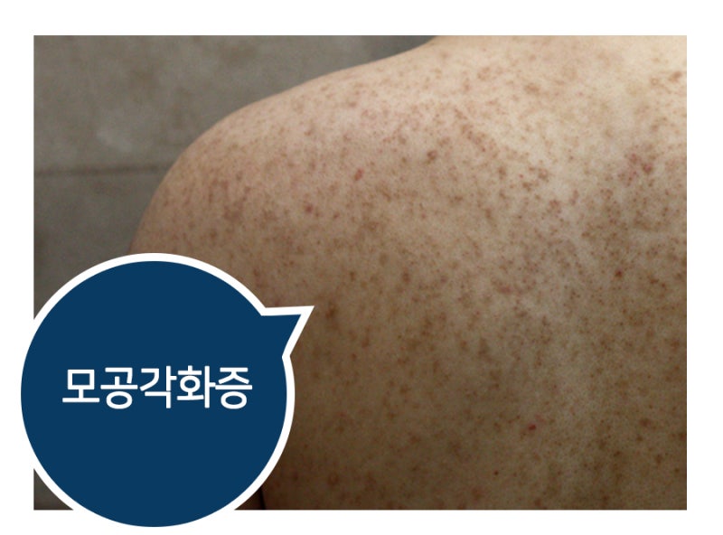 수원가슴여드름 색소침착 없애려면 1