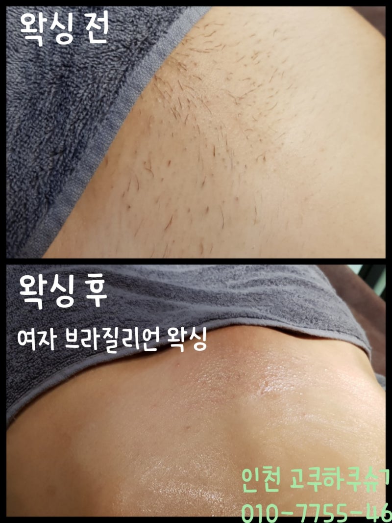 여자브라질리언왁싱 전후 : 네이버 블로그