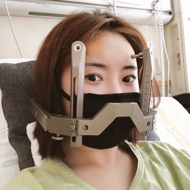뇌종양 투병일지 : 감마나이프 수술 후기