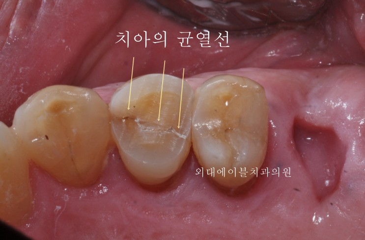 [이문동, 회기동 치과] 치아 크랙, 치아 금가는 증상 관련 기사