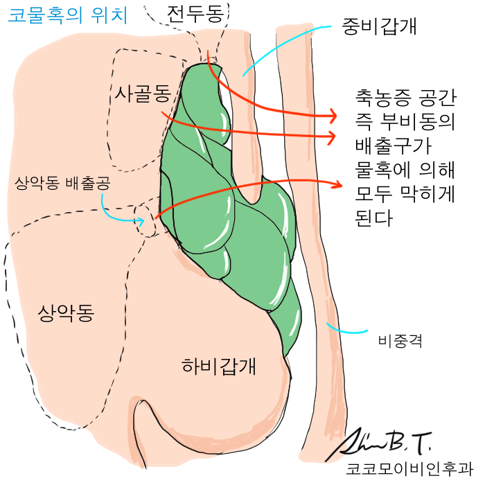  축농증 코물혹 수술에서 녹는 지혈솜으로 통증을 없앨 수 있었던 저만의 후기