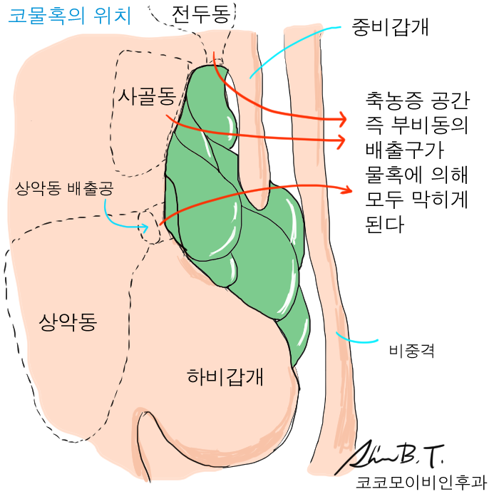 축농증 코물혹 수술에서 녹는 지혈솜으로 통증을 없앨 수 있었던 저만의 후기