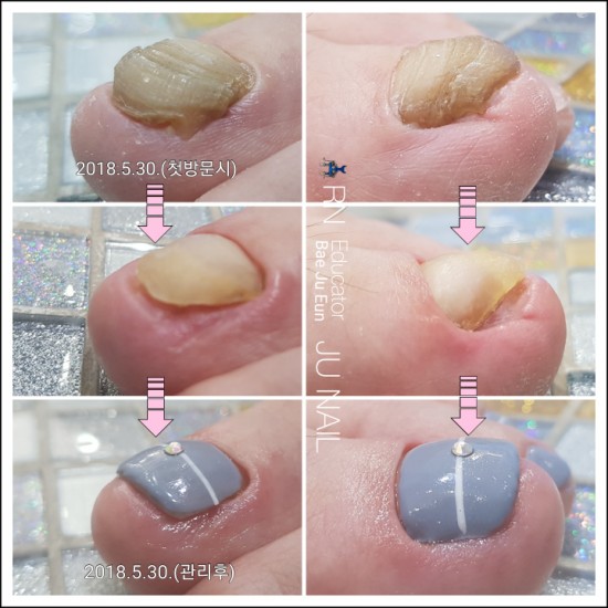 문제성발톱은고통/분당용인수원수지동백보정동죽전동/주네일/무좀발톱 문제성발톱은고통/분당용인수원수지동백보정동죽전동/주네일/무좀발톱