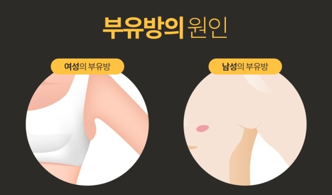 복부 지방 제거 비용 겨드랑이 덩어리 원인 및 통증 치료 병원 선택 비교 3