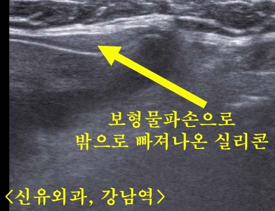파손된 가슴보형물제거하고 처진가슴 올리는 거상술도 함께 부분마취로만.