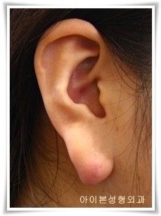 켈로이드는 어디서 제거하나요?