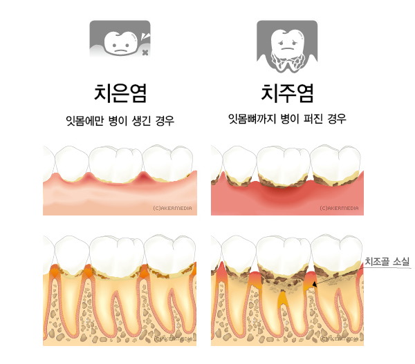  [진주치과/상대동치과추천]치주치료로 제2형 당뇨병 관리