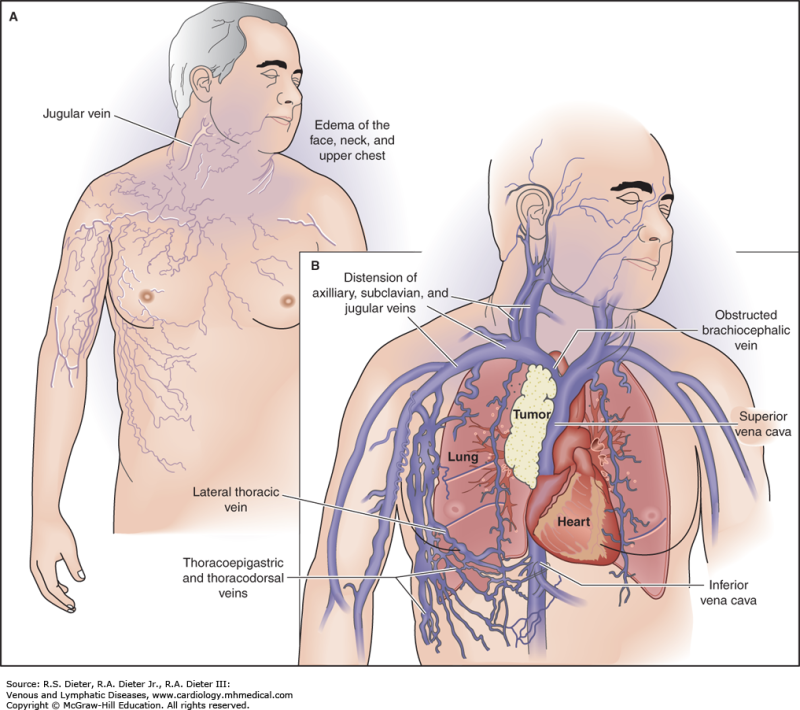 답답해지는 증상 상대정맥증후군의 치료 및 원인