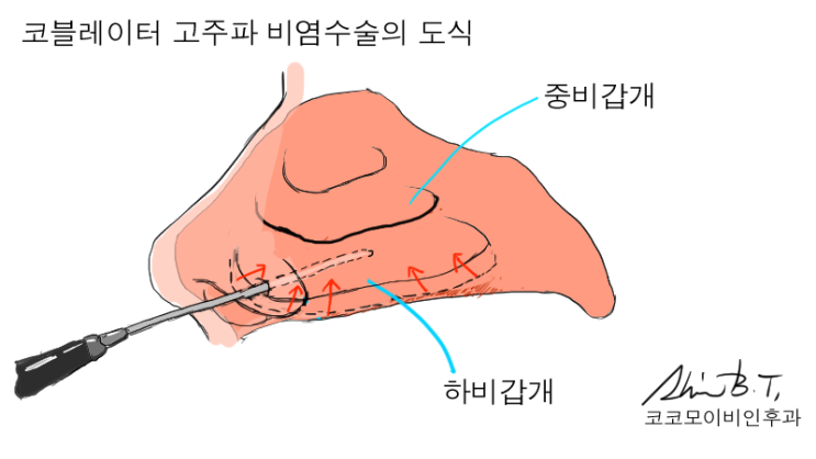  비염수술병원 하면 코코모 이비인후과