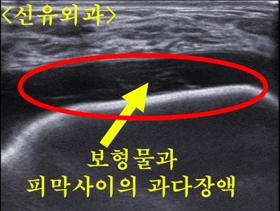 과다장액 비유착 가슴보형물제거교체하고 구형구축 생긴 피막도 제거