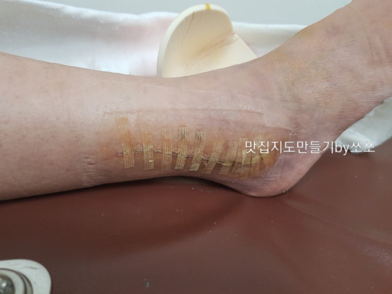 발목(복숭아뼈) 골절 핀제거수술 후기 및 3주 경과 상태
