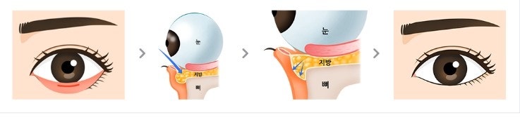 불룩한 눈 밑 고민을 해결해보세요~