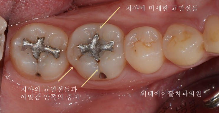 [이문동, 회기역 치과] 치아 금가는 경우, tooth crack syndrome 2편 - 치료 프로토콜