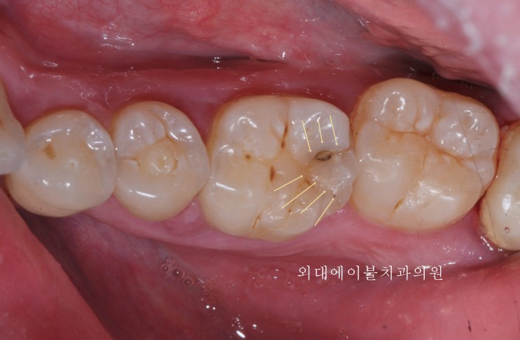 [이문동, 회기동 치과] 금이 간 치아의 치료 (신경치료, 보철치료)