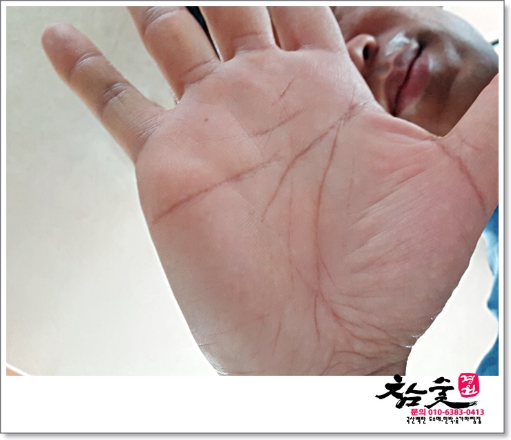 손금보고 얼굴점 빼기(얼굴점은 대부분 안좋다)