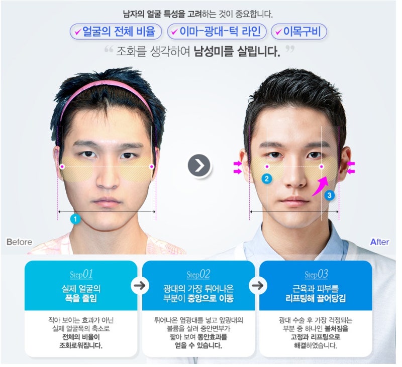 부드러운 인상으로 이미지 개선, 남자 광대수술 : 네이버 블로그 부드러운 인상으로 이미지 개선, 남자 광대수술 : 네이버 블로그