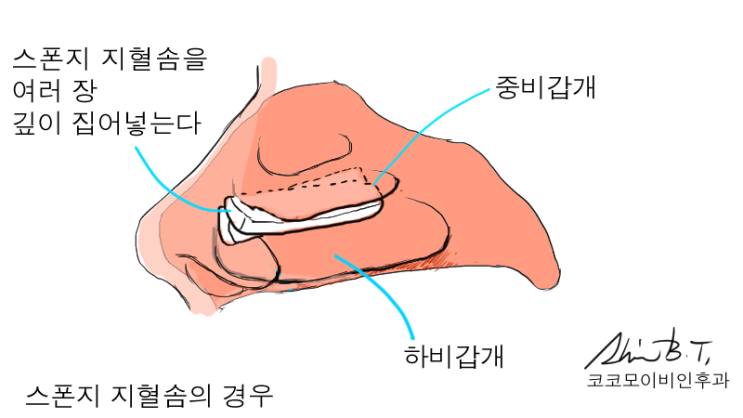 코 물혹, 비용종(혹은 코 폴립)과 축농증 수술에 대해서