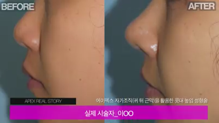 코 성형하면 에이펙스성형외과!!
