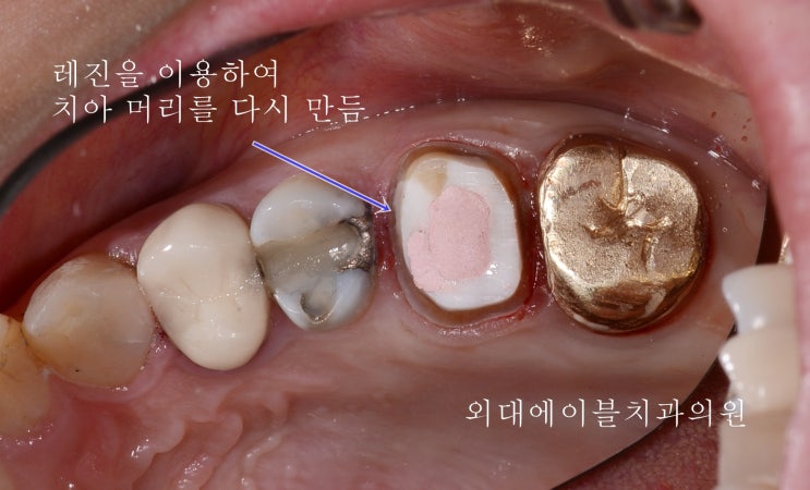 치아보존치료, 오래된 크라운도 뜯어야 하나요?