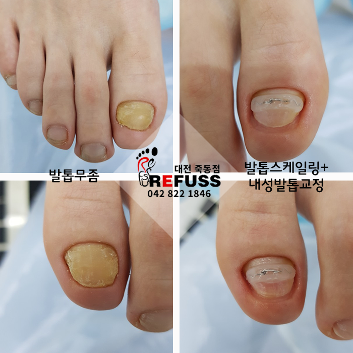 레푸스 :: 전주 혁신도시 내성발톱