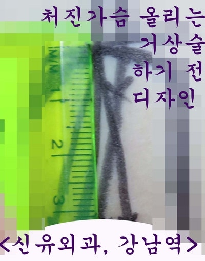 과다박리된 방을 찝고, 뒤집어진 가슴보형물을 제거교체하며 처진가슴 올리는 거상술도