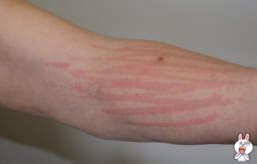 광주 피부묘기증 가볍게 넘기기 쉬운 피부질환 3