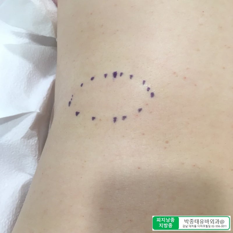 [Dr.ParK] 등 깊숙한 곳에서 혹이 만져집니다. 근막에 둘러싸인 지방종 제거 수술 7