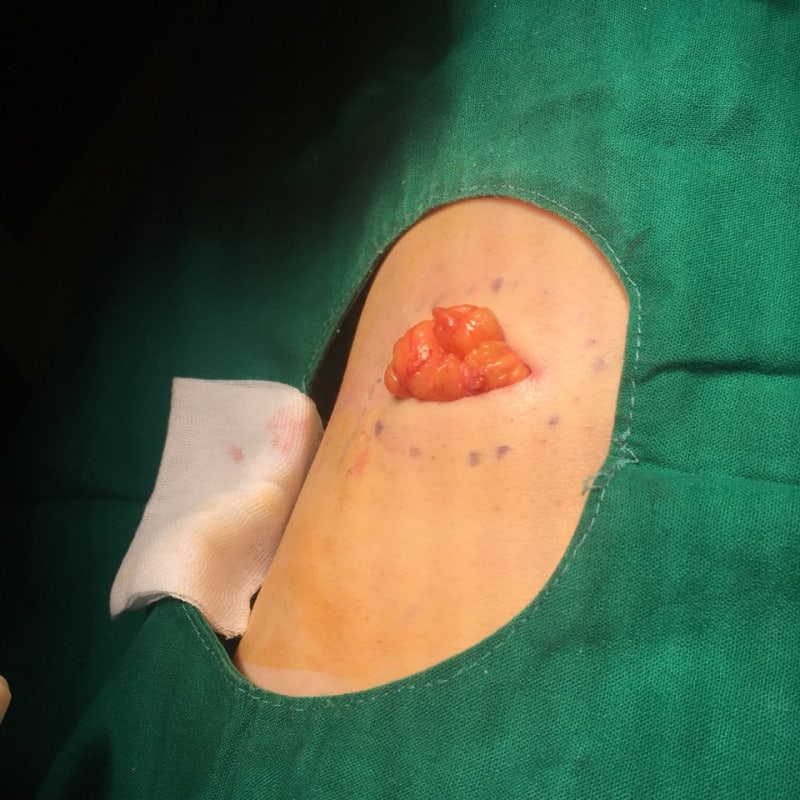 [Dr.ParK] 등 깊숙한 곳에서 혹이 만져집니다. 근막에 둘러싸인 지방종 제거 수술 2