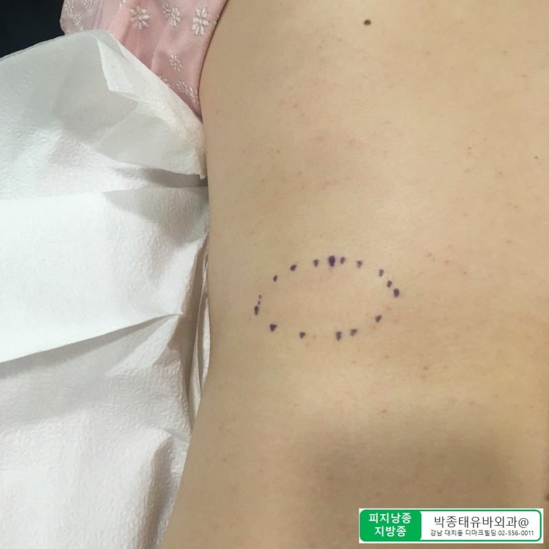 [Dr.ParK] 등 깊숙한 곳에서 혹이 만져집니다. 근막에 둘러싸인 지방종 제거 수술