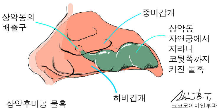  코 물혹 수술과 축농증 수술을 동시에 받으신 주부 환자분의 사례