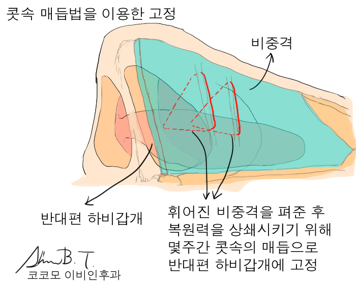  비중격만곡증 수술에서 메로셀 지혈솜에 의한 통증 줄이기