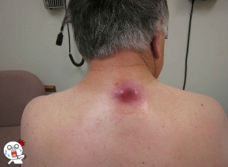 잇몸염증 고름, 치과치경치료 시 엠드게인, 잇몸골이식을 시행하는 경우: 치은박리 소파술로 풍치치료 6