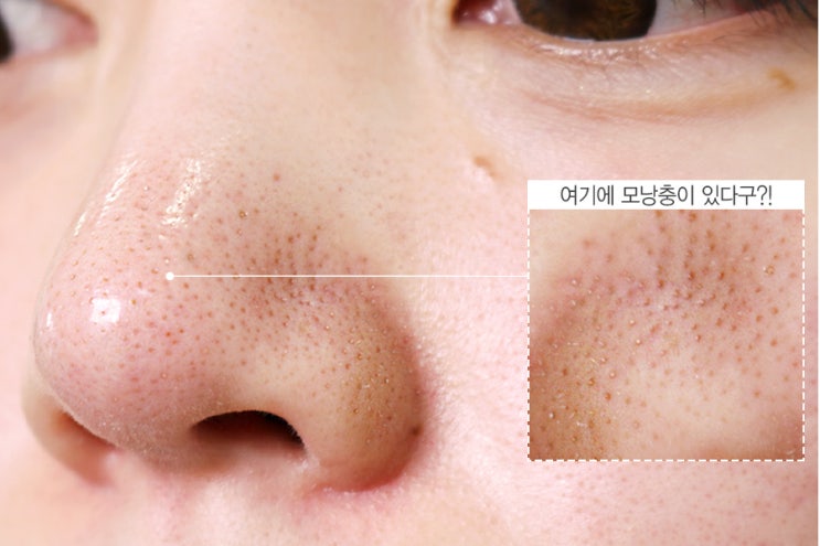  나는 몸신이다 양배추팩 만드는Tip & 모낭충 다이어트편
