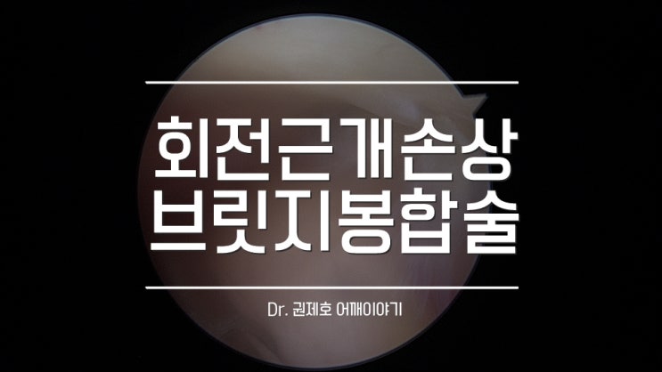  회전근개파열 치료 늦어지면 안 돼요!