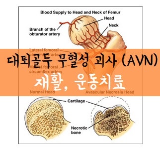고관절무혈성괴사 재활 운동 치료
