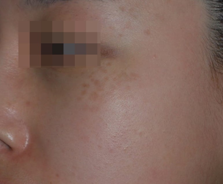 후천양측오타모반모양반점(ABNOM, Hori’s nevus) : 네이버 블로그