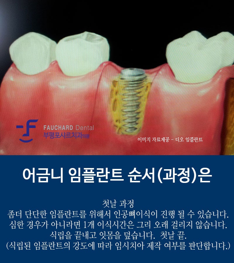 임플란트 시술 이미지 개선 및 차이점