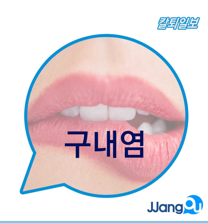  구내염예방법