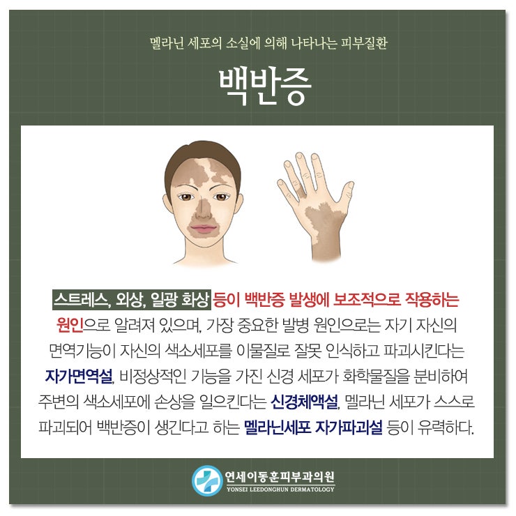 순천백반증 멜라닌 세포때문에 발생하게 되는 질환! : 네이버 블로그